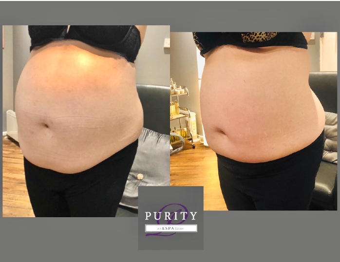 Cavitation, Radio Frequency and Shockwave Fat Loss Treatment
