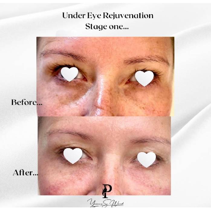 Eye Rejuvenation Three