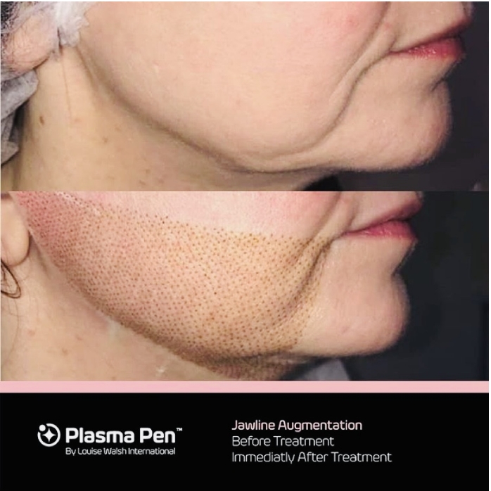 Jawline Augmentation Before Treatment Immediatly After Treatment