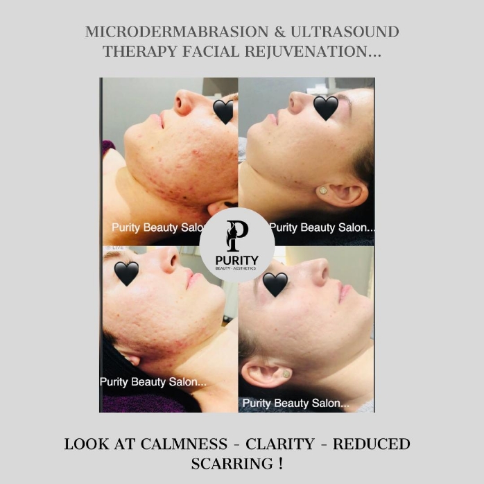 Microdermabrasion & Ultrasound Therapy Facial Rejuvenation