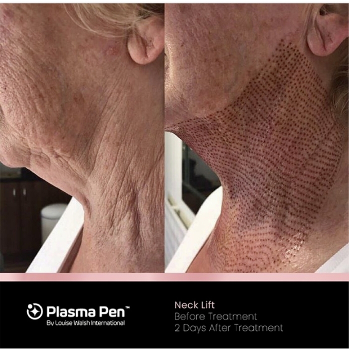 Neck Lift Before Treatment - 2 Days After Treatment
