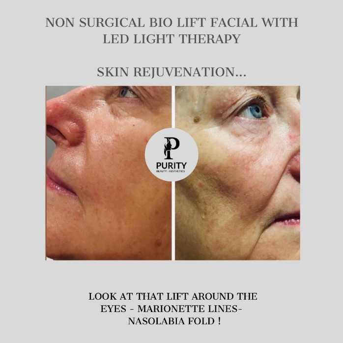 Non Surgical Bio Lift Facial With LED Light Therapy - Skin Rejuvenation