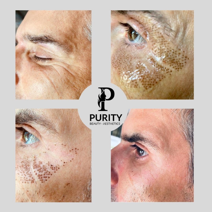 Plasma Non-Surgical, Non-Invasive Treatments - Before & After