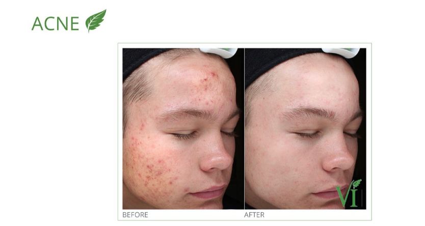 Medical Facial Peel For Acne
