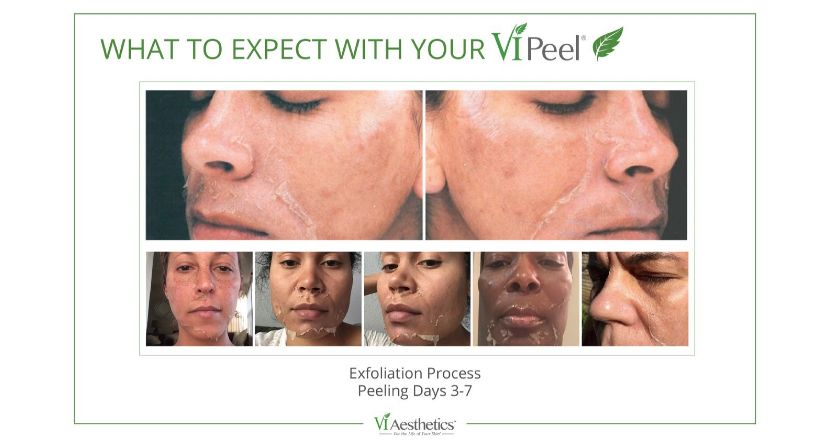 What To Expect With Your VI Peel